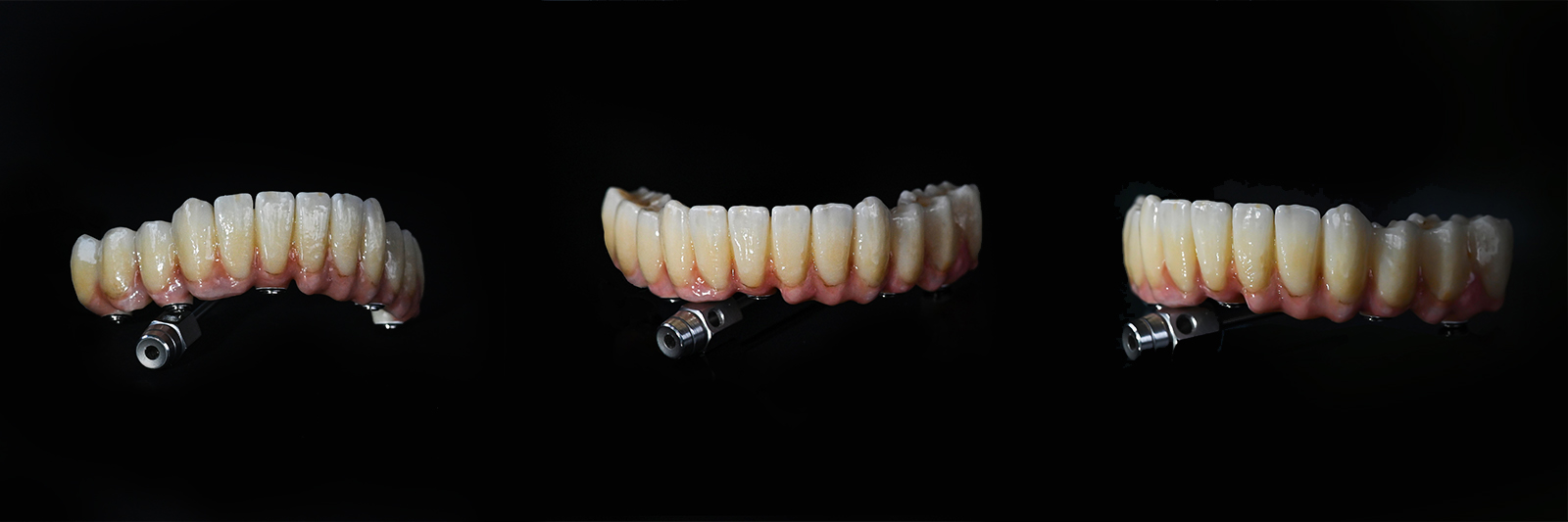 Vollkeramikbrücke auf Implantaten